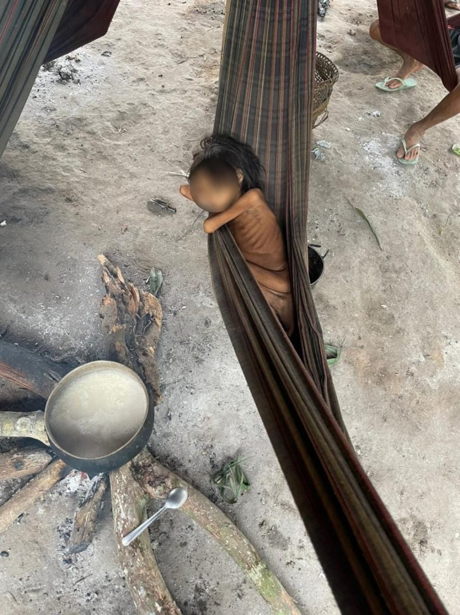 Criança Yanomami apresenta sinais de desnutrição e fraqueza
